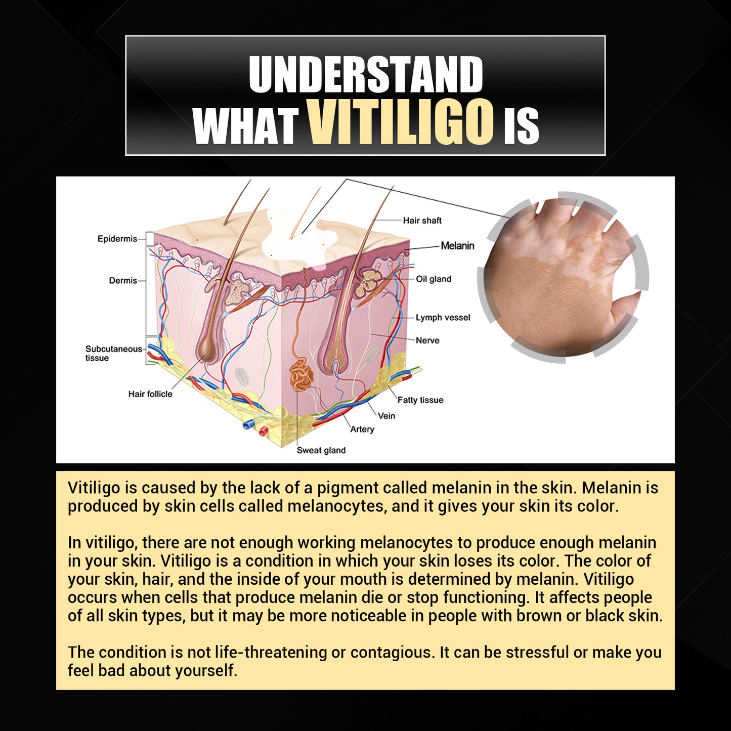 Vitiligo Removal Relief Spray, Repair Whitening Spot Perspiration Beauty Moisturizing Skin Care spray Health Eprolo https://www.cyberehub.com