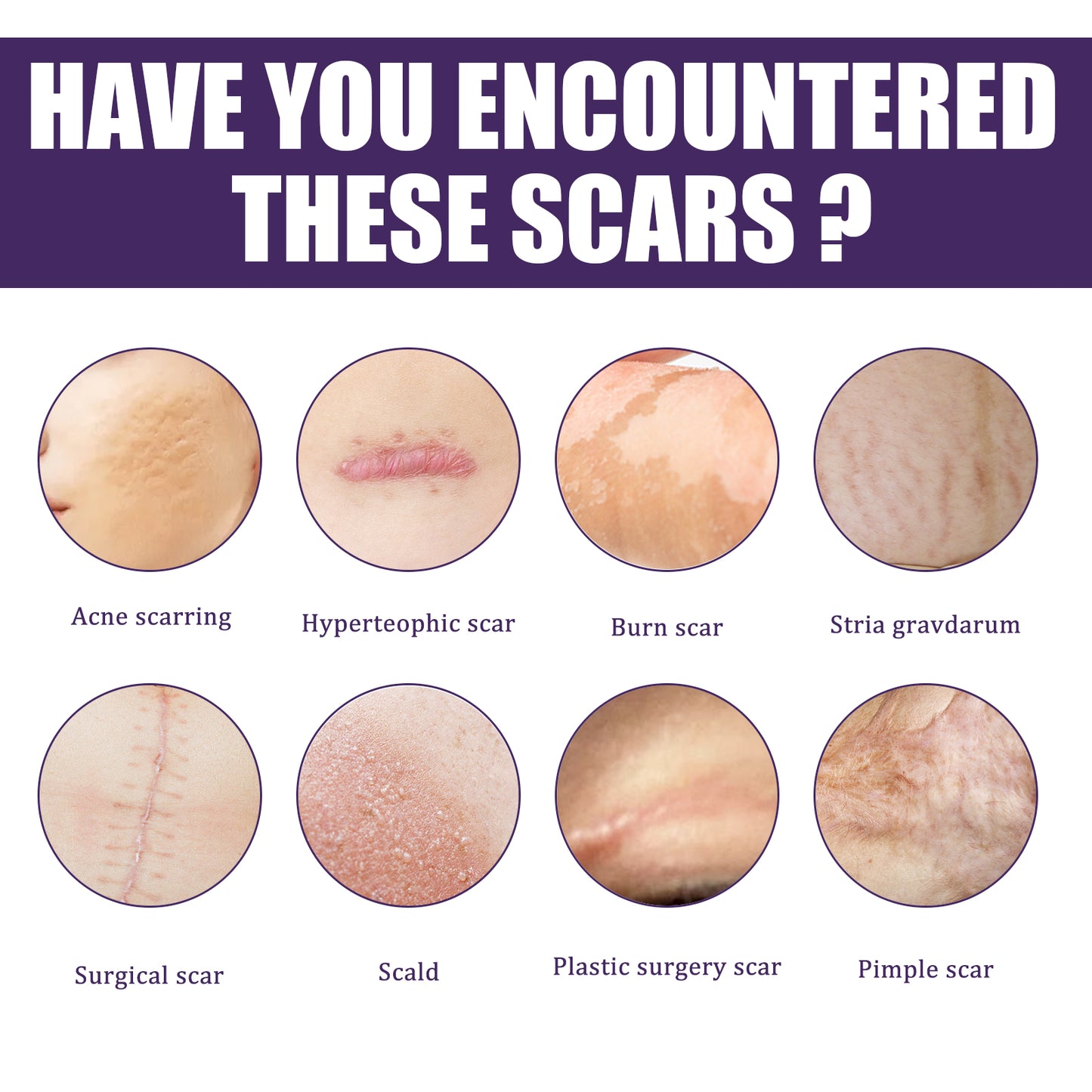 Silicone Scar Patch, Reduces Stretch Marks And Hyperplasia Of Caesarean Section Scars Silicone Patch Health Eprolo https://www.cyberehub.com
