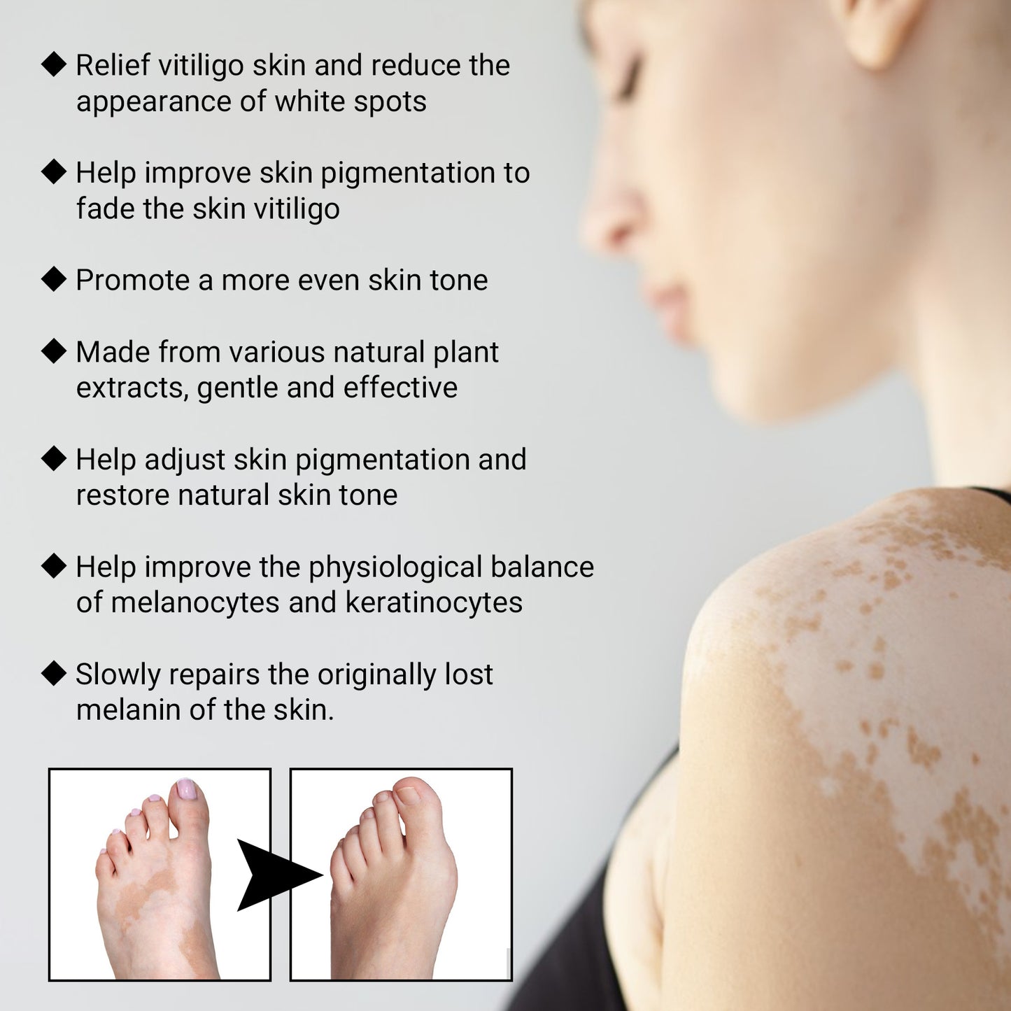 Vitiligo Removal Relief Spray, Repair Whitening Spot Perspiration Beauty Moisturizing Skin Care spray Health Eprolo https://www.cyberehub.com
