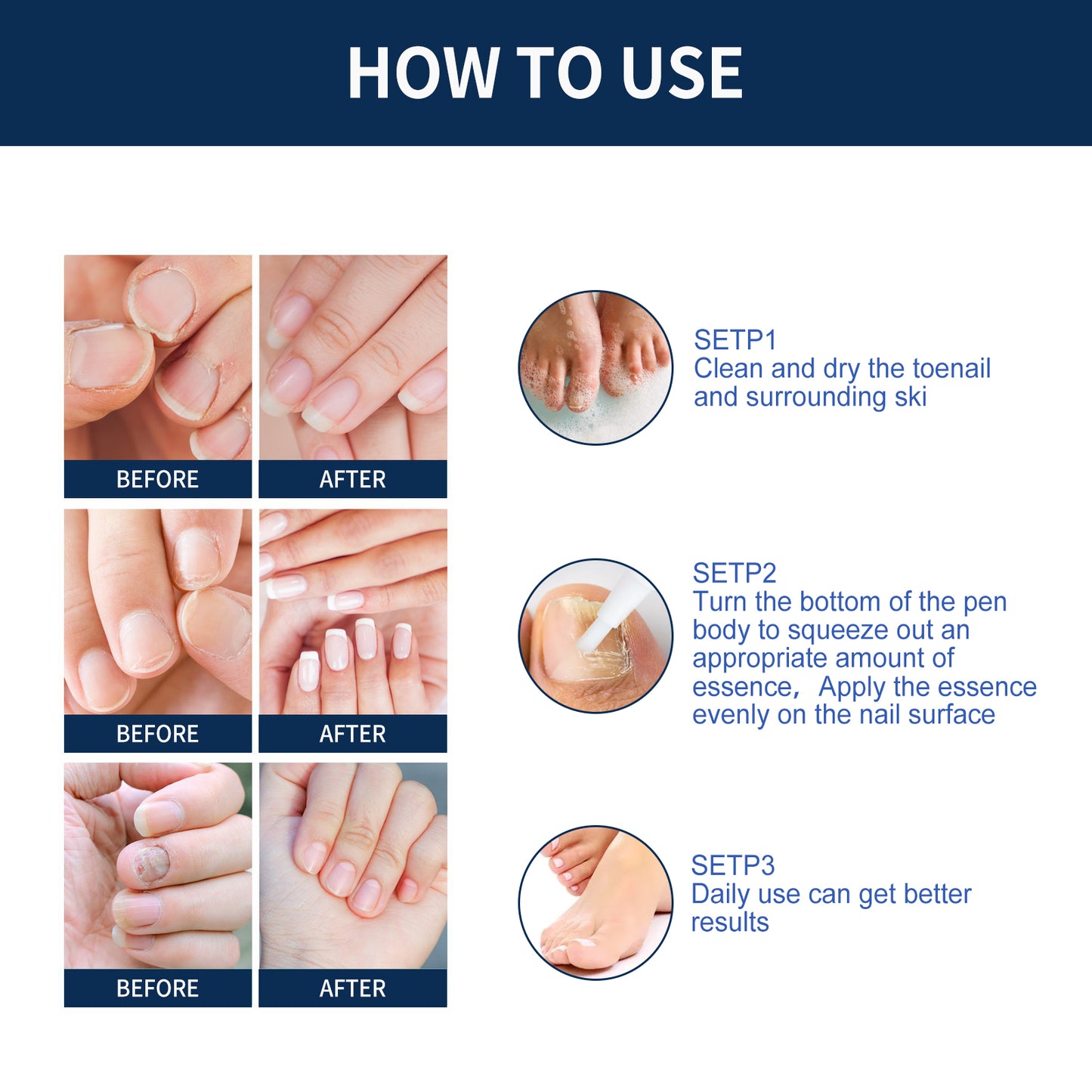 Nail Repair Relieve Essence Pen, Moisturizing Repair Hand And Foot Inlay Nail Thickening Grey Nail Correction Pen Health Eprolo https://www.cyberehub.com