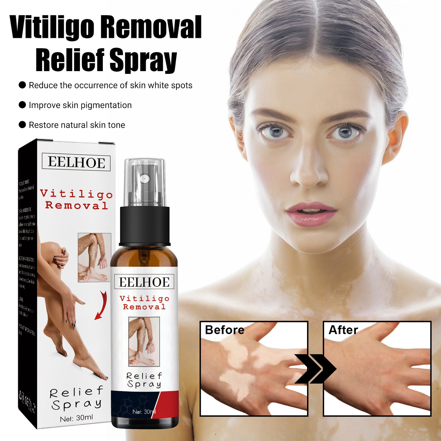 Vitiligo Removal Relief Spray, Repair Whitening Spot Perspiration Beauty Moisturizing Skin Care spray Health Eprolo https://www.cyberehub.com