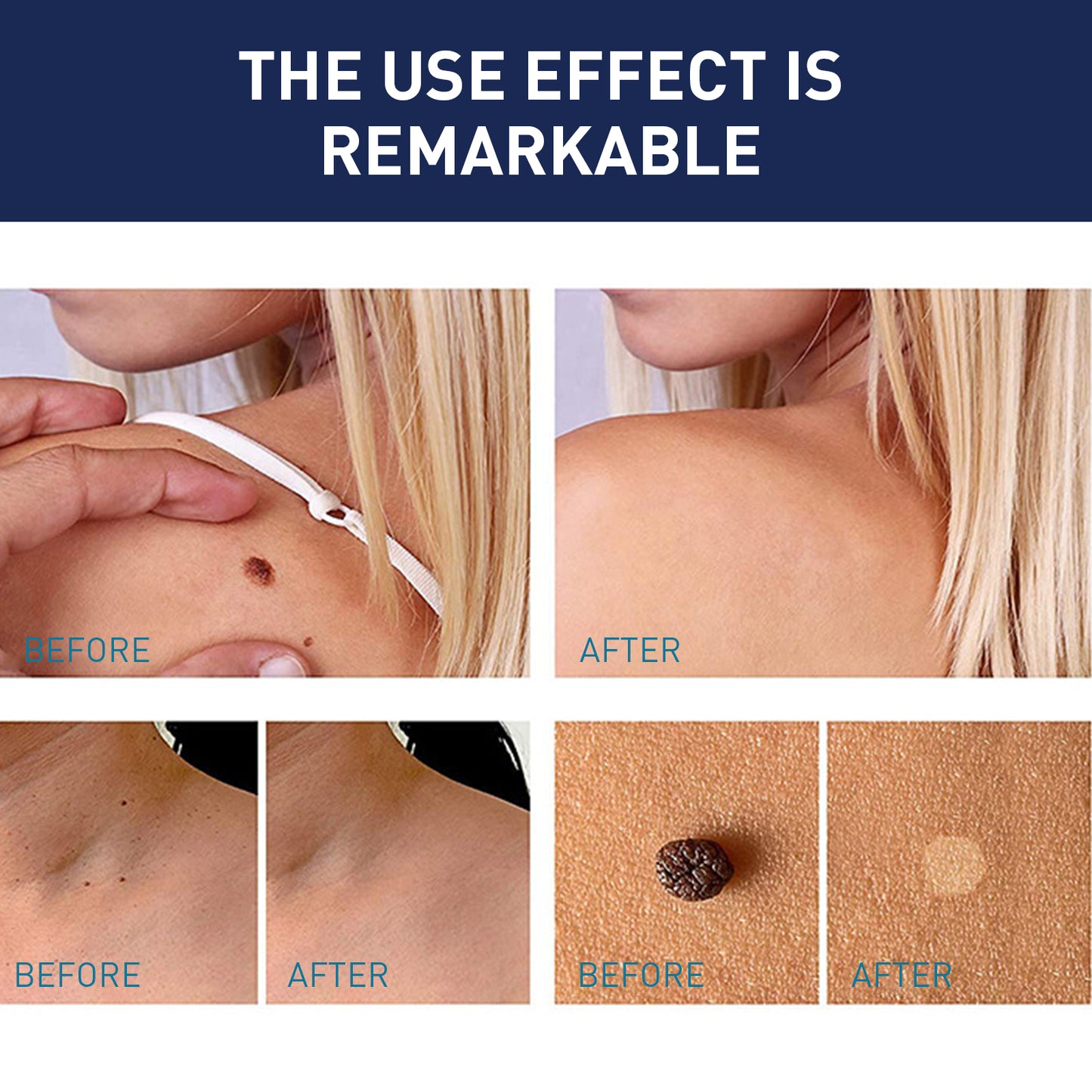Kwart Patch, Clean And Fade Skin Moles Moles Corns Filamentary Warts Body Skin Care Flat Wart Patch Health Eprolo https://www.cyberehub.com