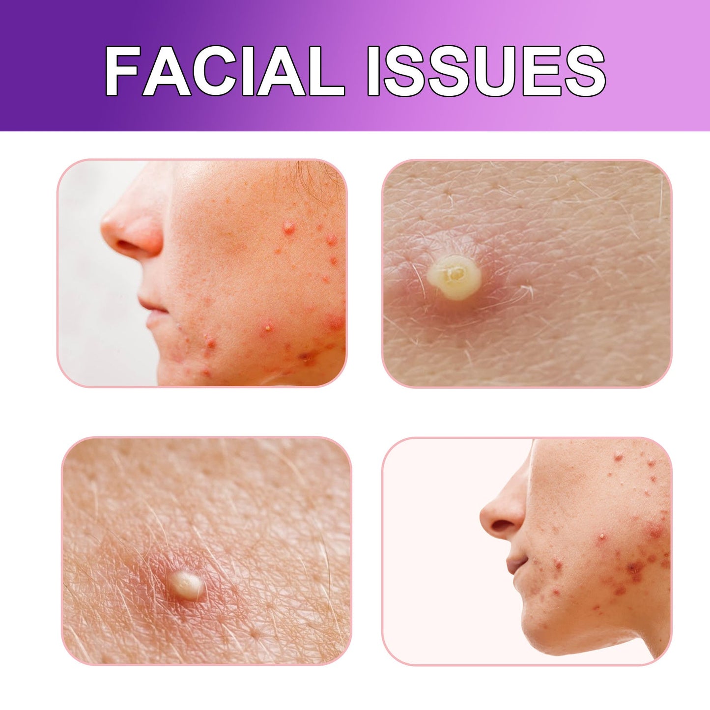 Diminish Facial Acne And Pimple Patches Health & Beauty Health & Beauty Under 10 UniversalMaax https://www.cyberehub.com