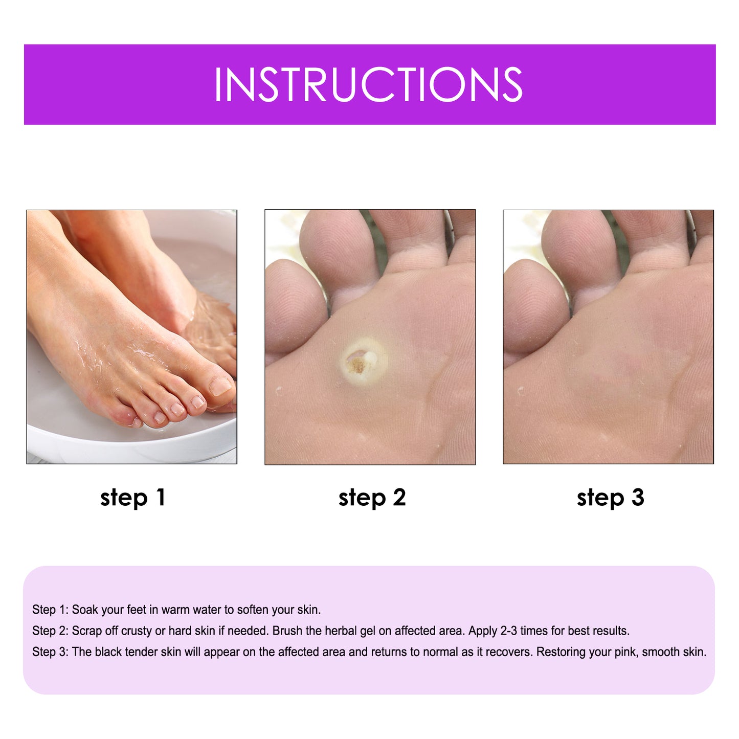 Remove Chicken Eye Lotion Extra Clear Remove Corns Skin Care Chicken Calluses Foot Pad Gram Warts Health Eprolo https://www.cyberehub.com