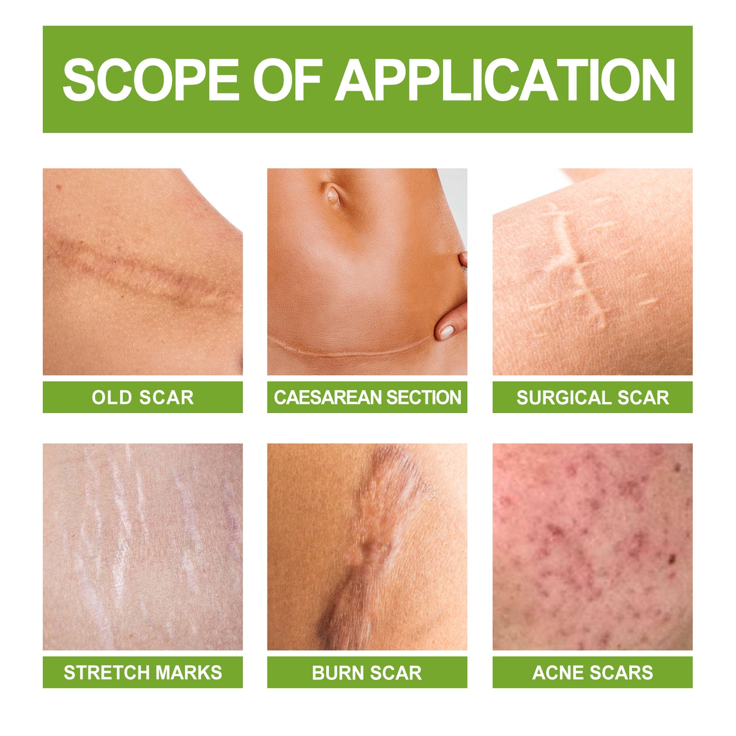 Scar Repair Serum Reduces Scar Acne Mark Pregnancy Surgery Scar Repair Smooth Skin Care Health Eprolo https://www.cyberehub.com