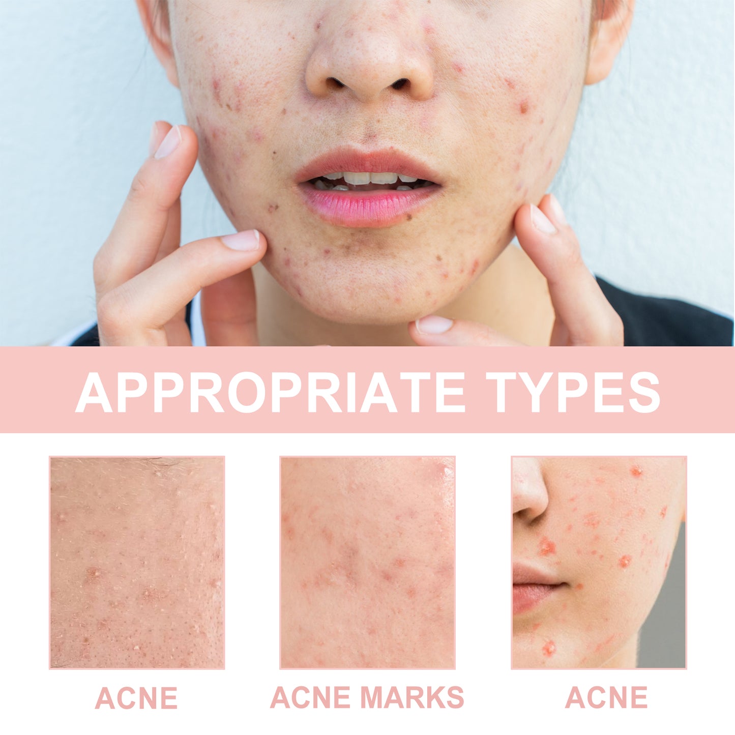 Acne Patch, Repair Acne Pimple Facial Redness Clean Pores Moisturize Skin Patch Health Eprolo https://www.cyberehub.com