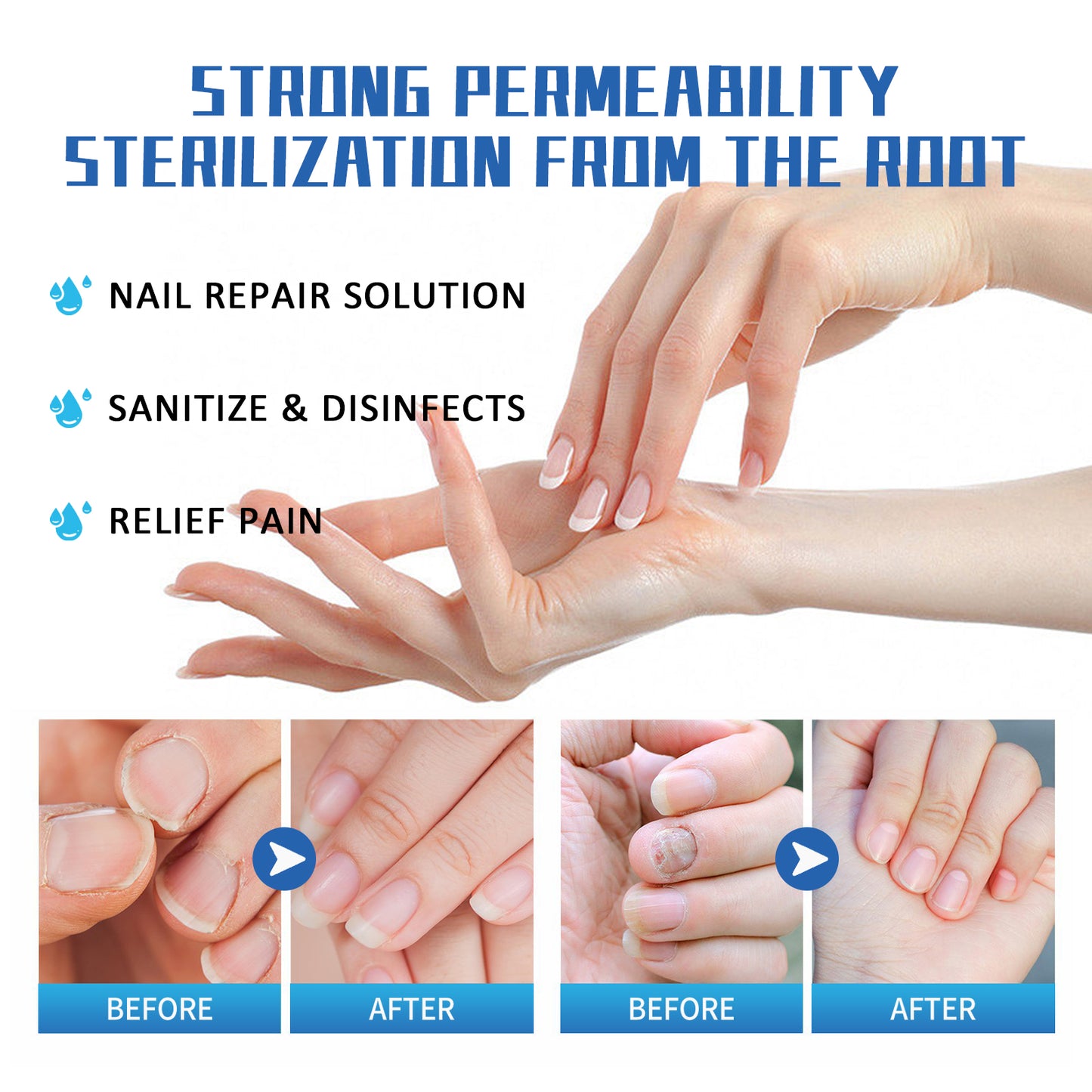 Nail Fungus Treatment Method, Repair Grey Nail Brightening Nail Thickening Nail Hand And Foot Nails Moisturizing Care Cream Health Eprolo https://www.cyberehub.com