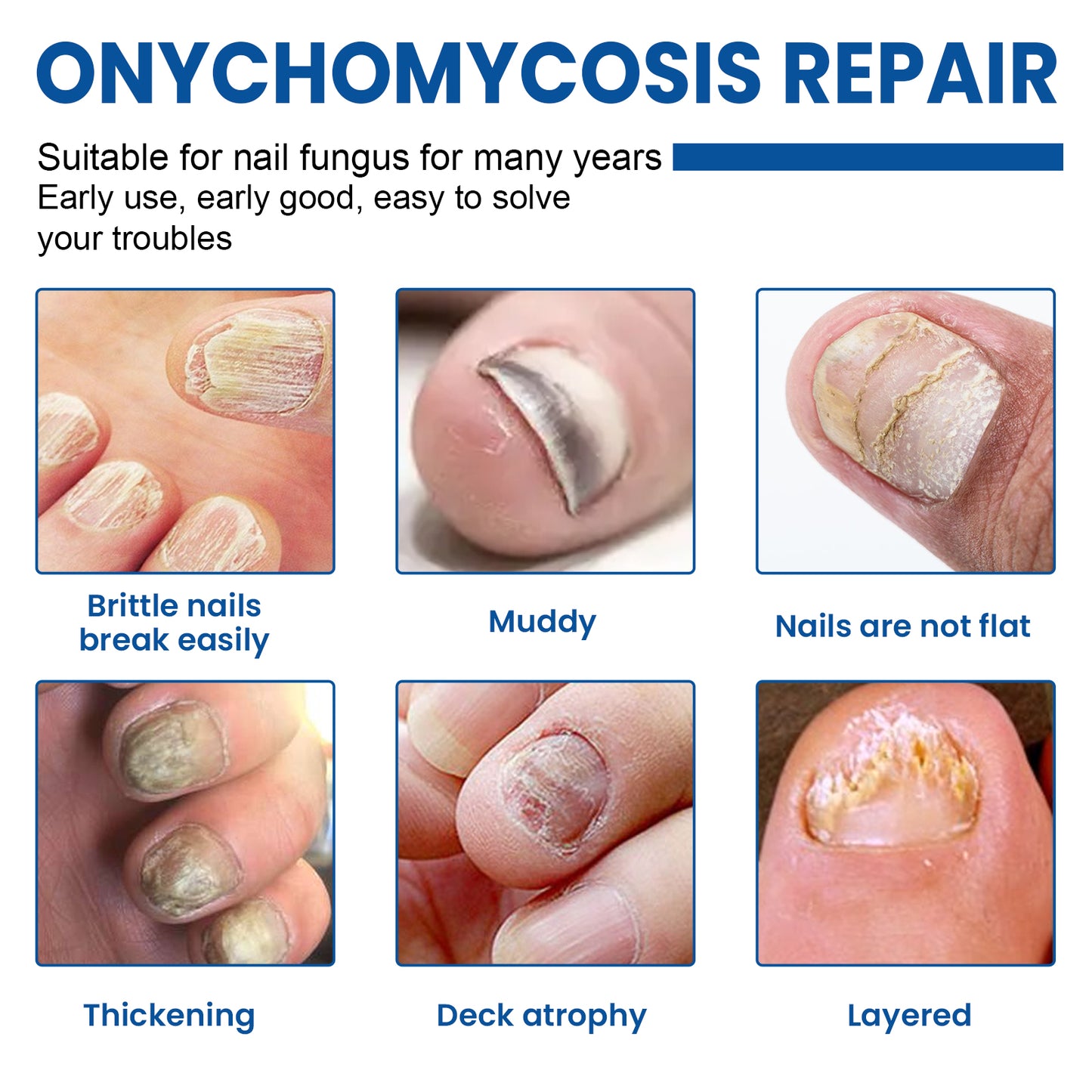 Nail Fungus Patches, Repair Hand And Foot Nails Inlaid Nail Thickening Gray Nail Brightening Nail Patch Health & Beauty Health Eprolo https://www.cyberehub.com