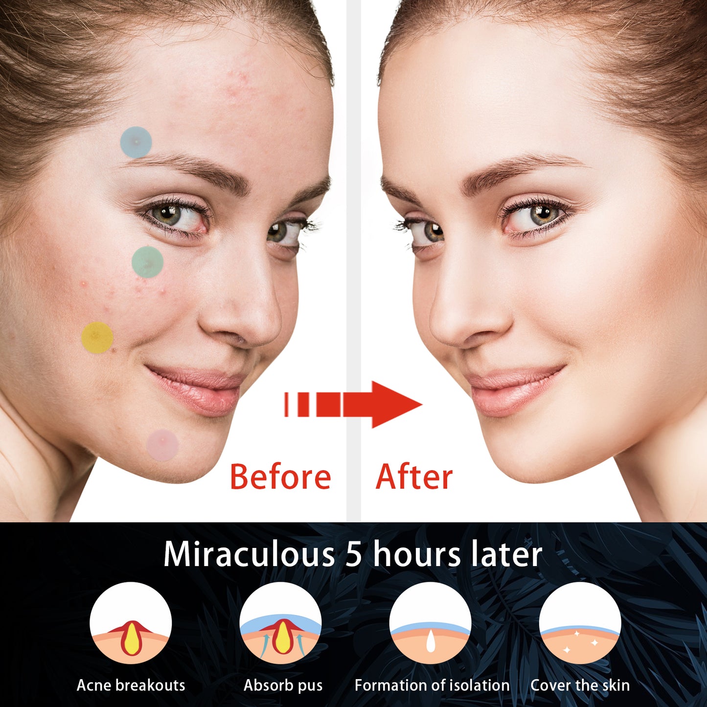Hydrocolloid Acne Patch, Mild Non-Irritant Lightening Acne Pimples Closed Mouth Improve Acne Muscle Hydrocolloidal Acne Patch Health Eprolo https://www.cyberehub.com