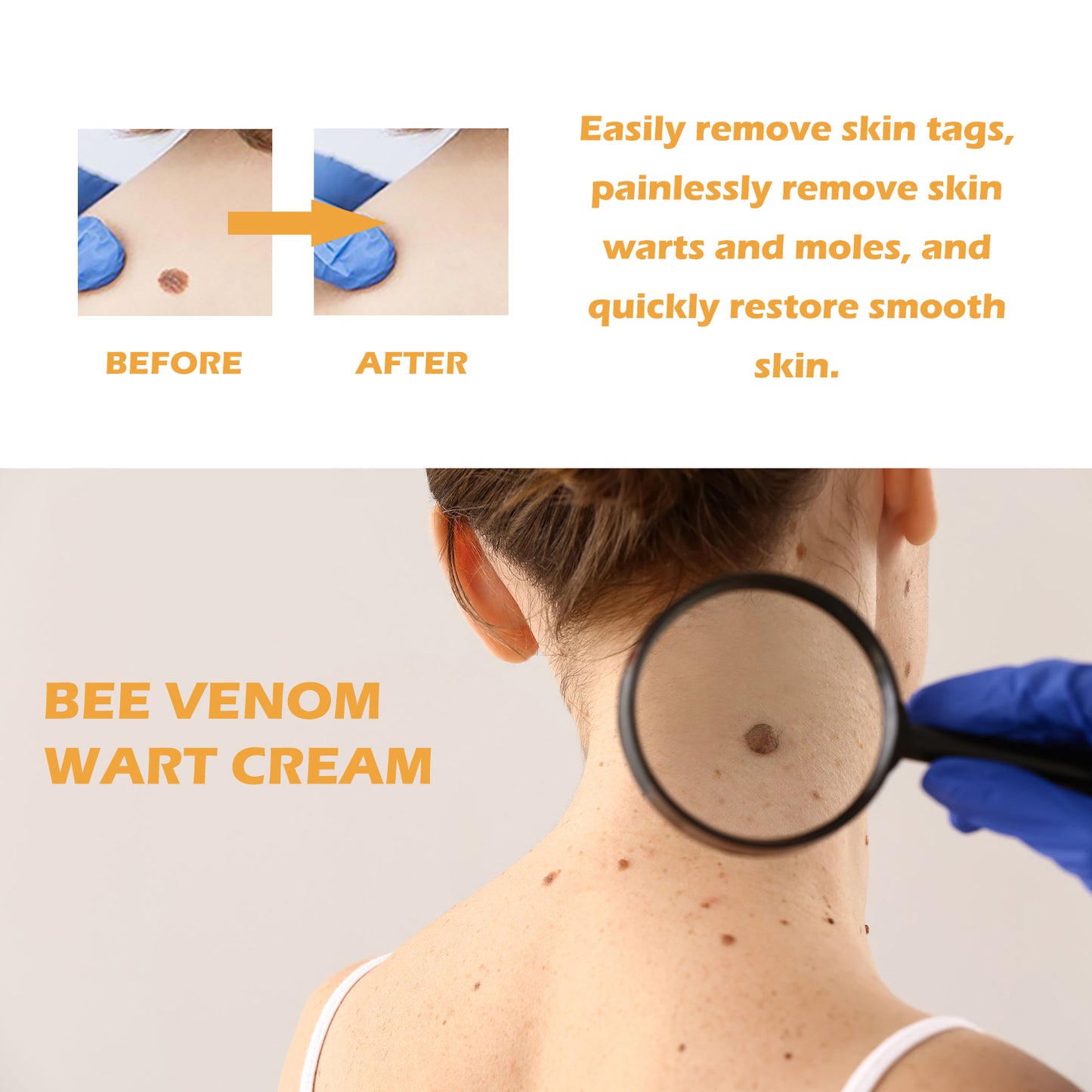 Ximonth Bee Venom Wart Cream, Repair Smooth Skin Lightening Nevus Spot Nevus Cure Wart Care Cream Health Eprolo https://www.cyberehub.com