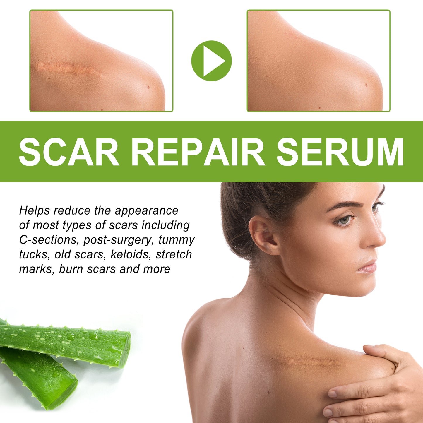 Scar Repair Serum Reduces Scar Acne Mark Pregnancy Surgery Scar Repair Smooth Skin Care Health Eprolo https://www.cyberehub.com
