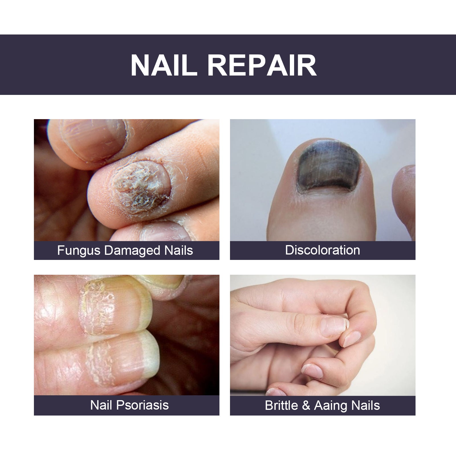 Nail Repair Essence, Soft Nail Thickening Nails Smooth Ingrown Toenails Grey Nails Repair Essence Health Eprolo https://www.cyberehub.com