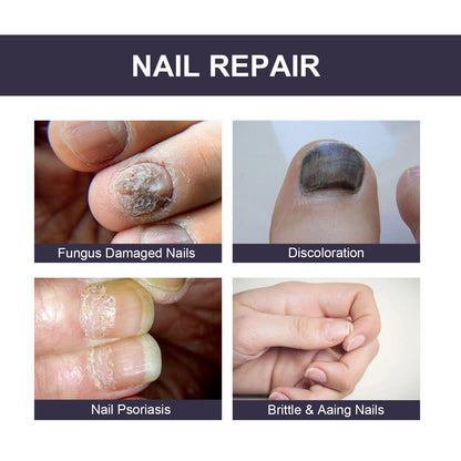 Nail Repair Essence, Soft Nail Thickening Nails Smooth Ingrown Toenails Grey Nails Repair Essence Health Eprolo https://www.cyberehub.com