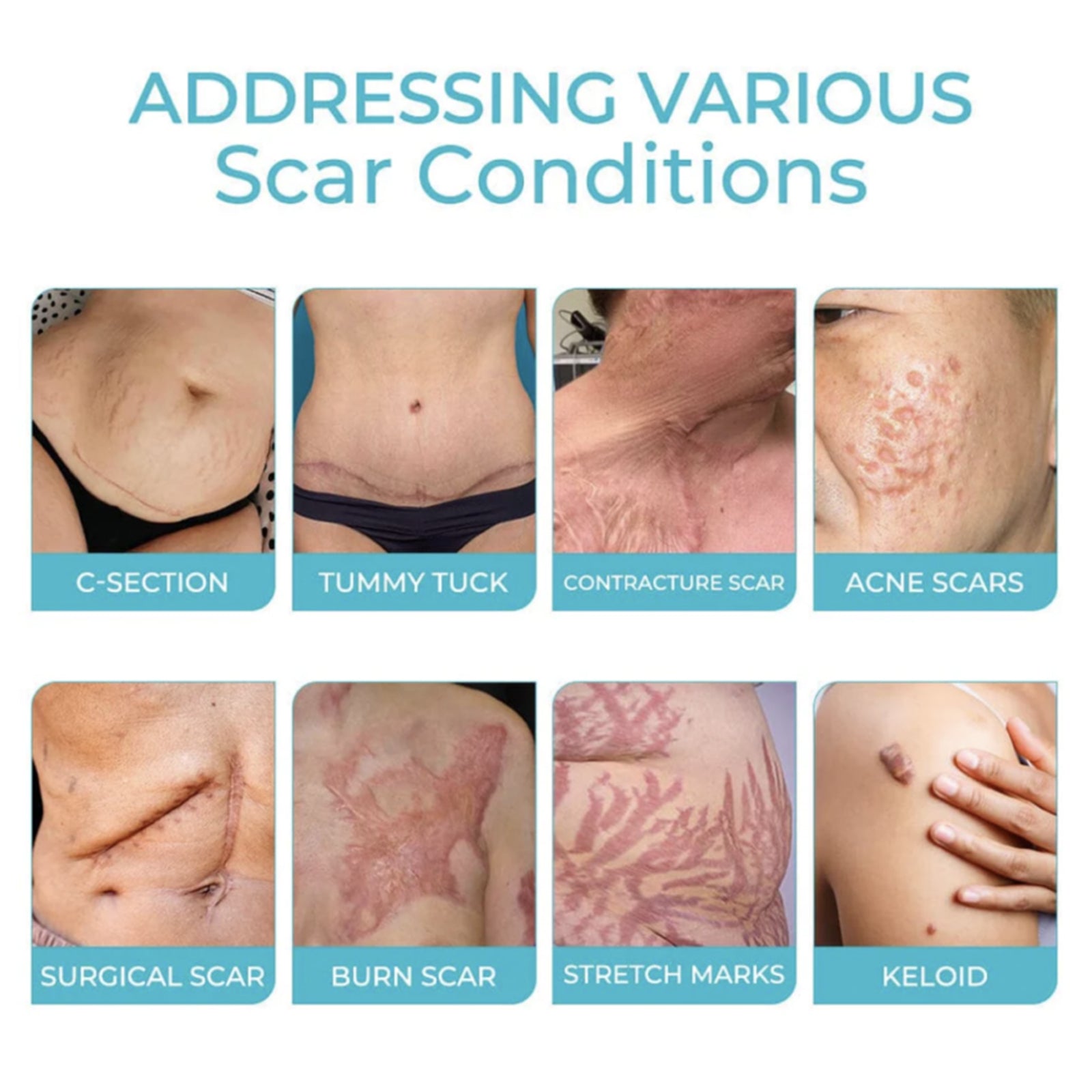 Scarfree Advanced Skin Spray, Body Skin Care Reduces Post-Natal Scars And Smooths Skin Health & Beauty Health Eprolo https://www.cyberehub.com