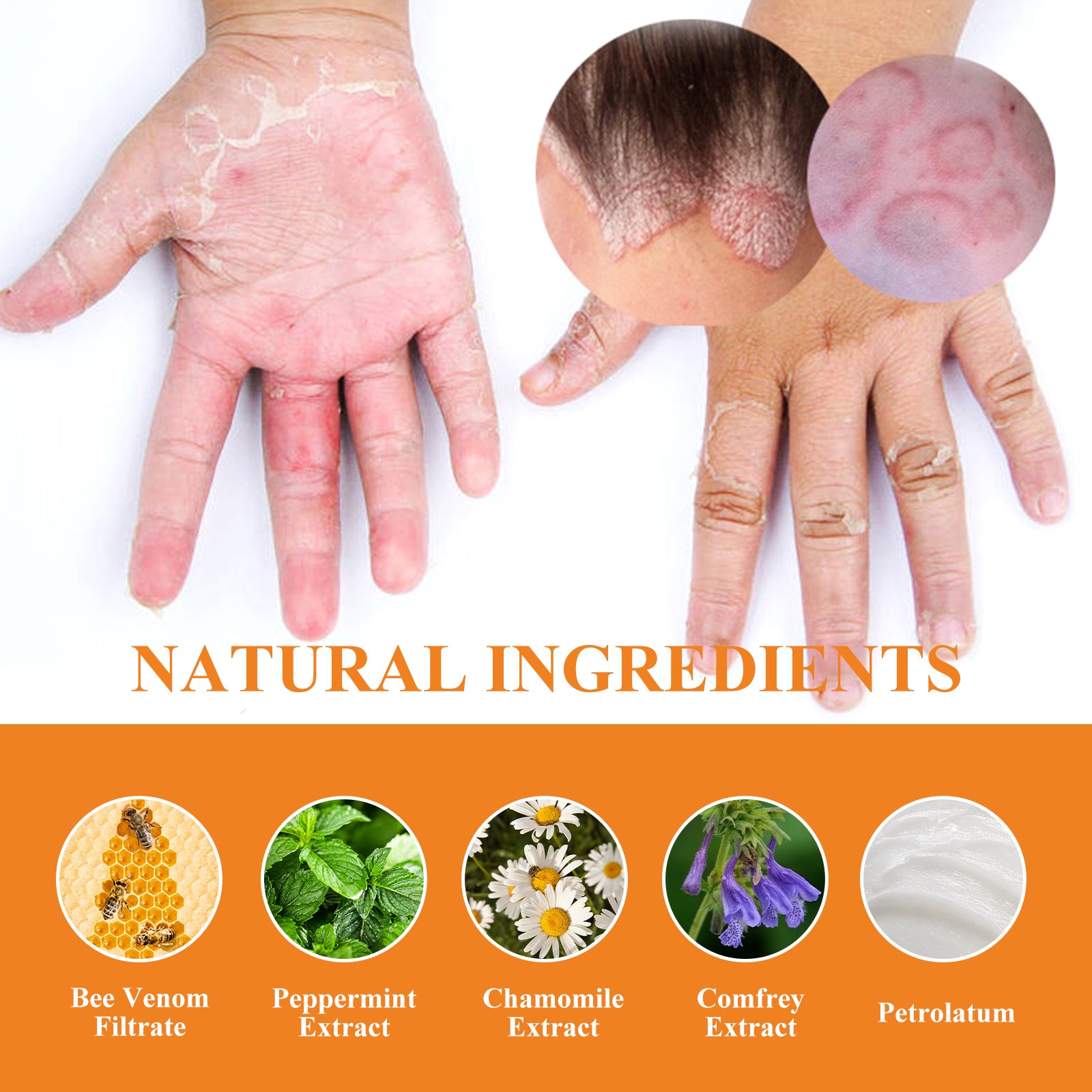 Bee Venom Psoriasis Cream, Relieve Itchy Skin Repair Hand Moss Moisturizing Skin Care Cream Health Eprolo https://www.cyberehub.com