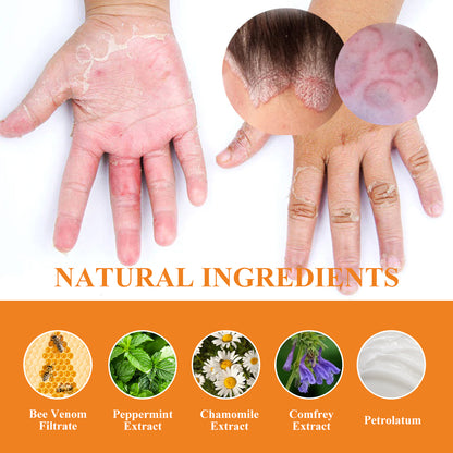 Bee Venom Psoriasis Cream, Relieve Itchy Skin Repair Hand Moss Moisturizing Skin Care Cream Health Eprolo https://www.cyberehub.com