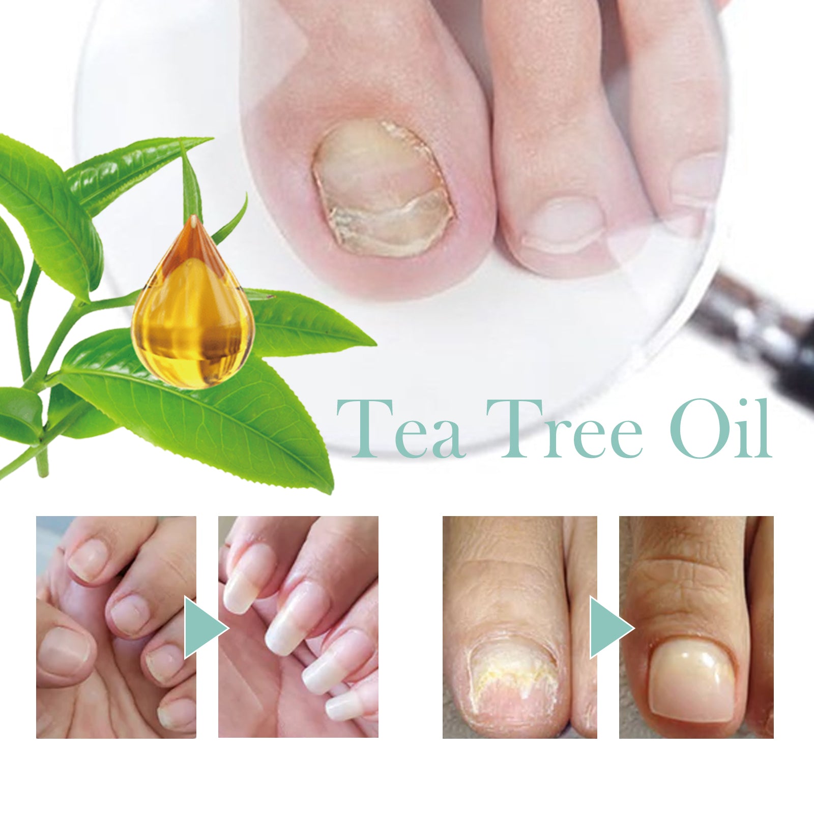 Nail Repair Pen Hand And Foot Gray Nails Cleaning Soft Nails Rotten Nails Thickening Nails Shining Nails Treatment Health Eprolo https://www.cyberehub.com