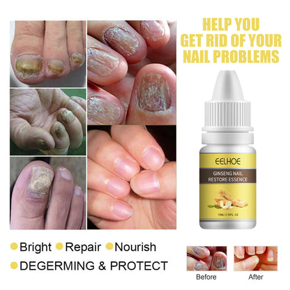 Ginseng Nail Essential Oil Grey Nail Thickening Nail Repair Brightening Nail Removing Soft Nail Moisturizing Essence Health Eprolo https://www.cyberehub.com