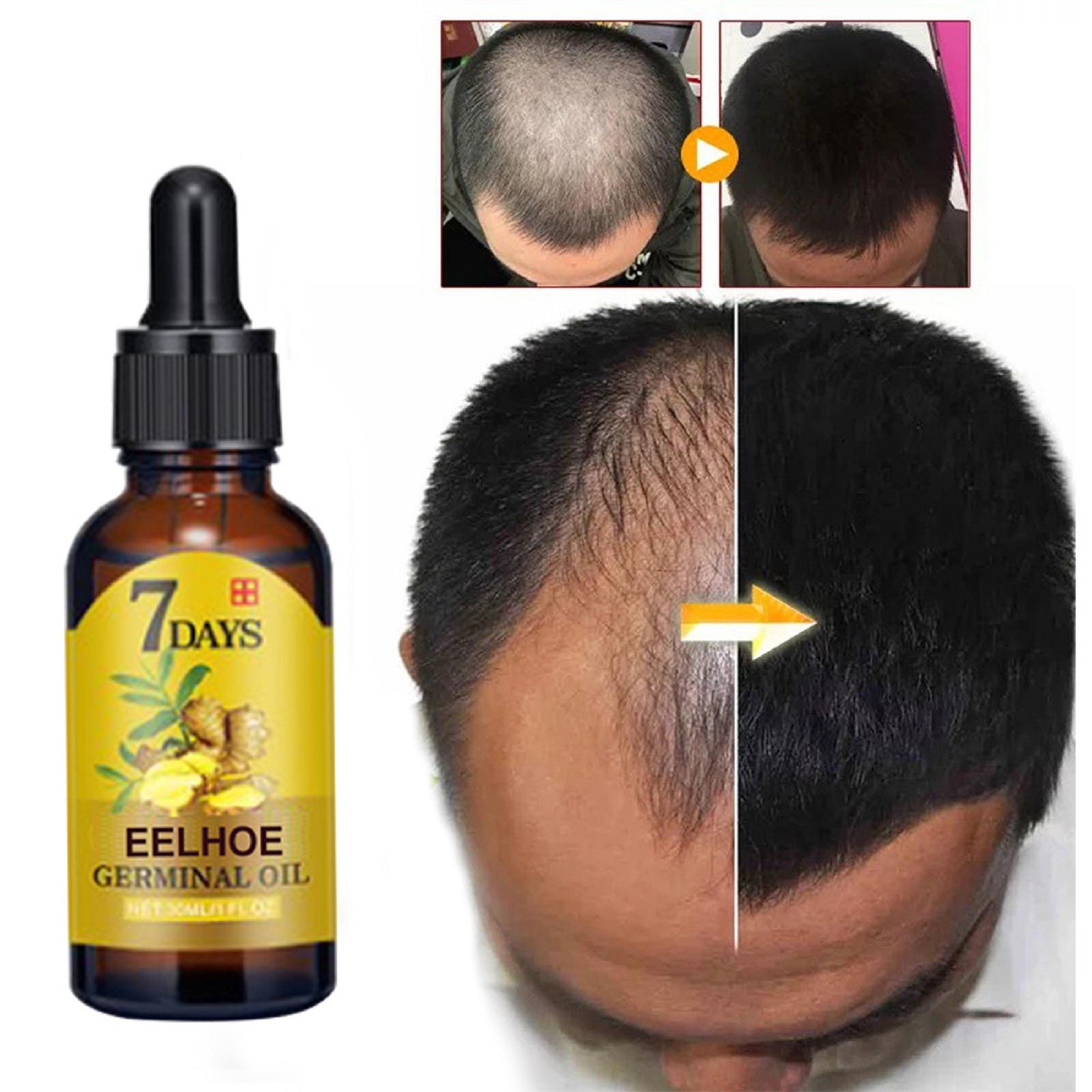 EELHOE Ginger Hair Care Solution For Hair Nourishing And Moisturizing Hair Care For Hair Stabilizing And Preventing Hair Loss Health Eprolo https://www.cyberehub.com