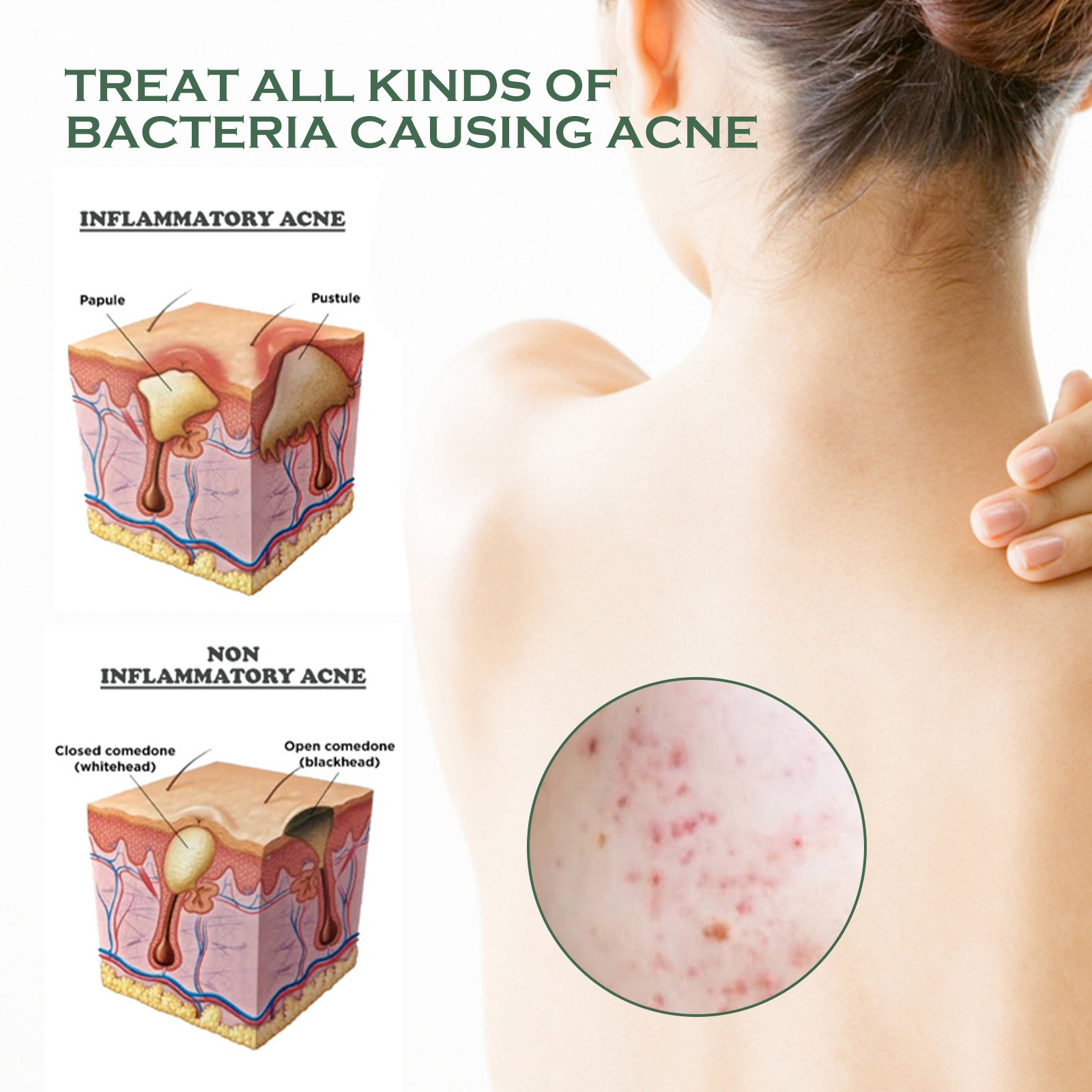 Body Acne Removal Cleanser Spray, Deep Clean Back Arm Fade Acne Beauty Moisturizing Spray Health & Beauty Health Eprolo https://www.cyberehub.com