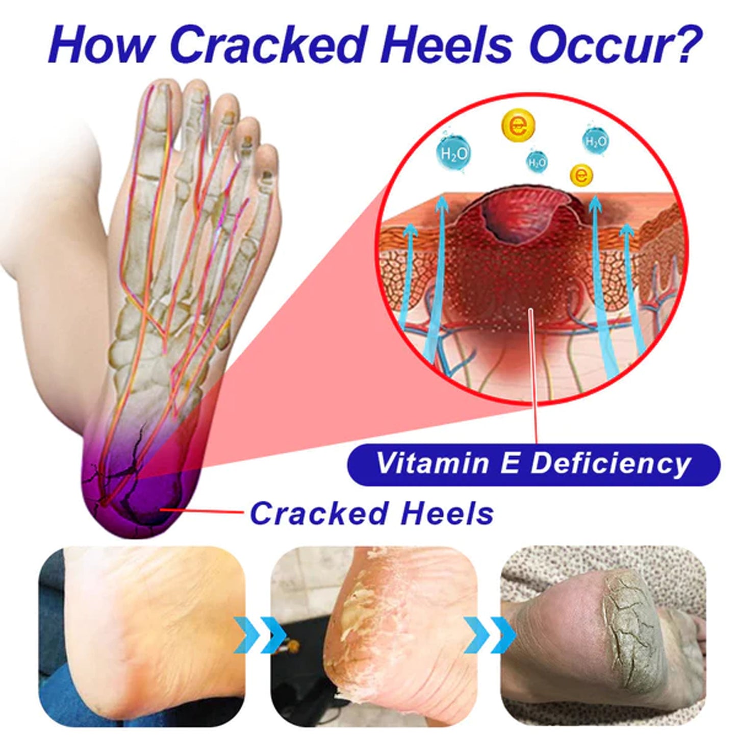 Heel Repair Cream Cleanses Dead Heel Calluses, Prevents Cracking And Peeling, And Moisturizes Foot Care Cream Health Eprolo https://www.cyberehub.com