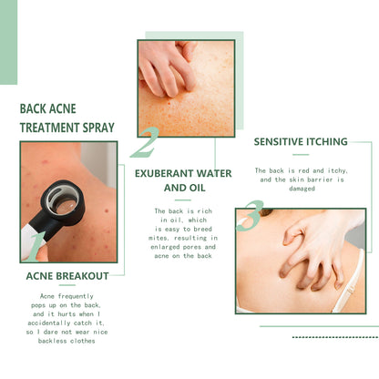 Body Acne Removal Cleanser Spray, Deep Clean Back Arm Fade Acne Beauty Moisturizing Spray Health & Beauty Health Eprolo https://www.cyberehub.com