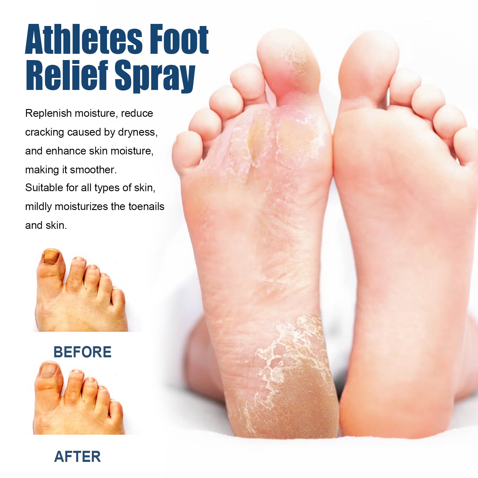 Athletes Foot Relief Spray, Relieve Foot Sweat Foot Itching Peeling Gray Nails Foot Odor Moisturizing Care Spray Health Eprolo https://www.cyberehub.com