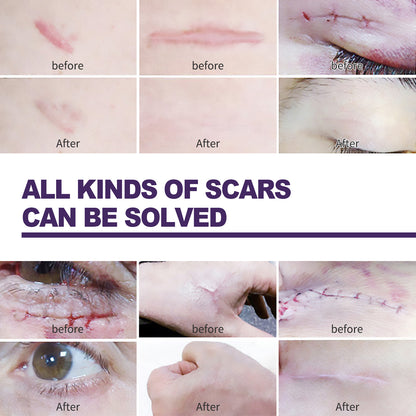 Silicone Scar Patch, Reduces Stretch Marks And Hyperplasia Of Caesarean Section Scars Silicone Patch Health Eprolo https://www.cyberehub.com