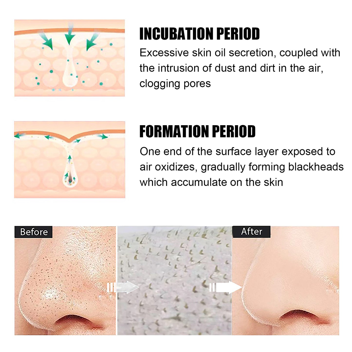 Blackhead Remover Nose Mask, Deeply Cleans And Closes Pore Blackheads And Acne Barbs And Nose Remover Mask Health Eprolo https://www.cyberehub.com