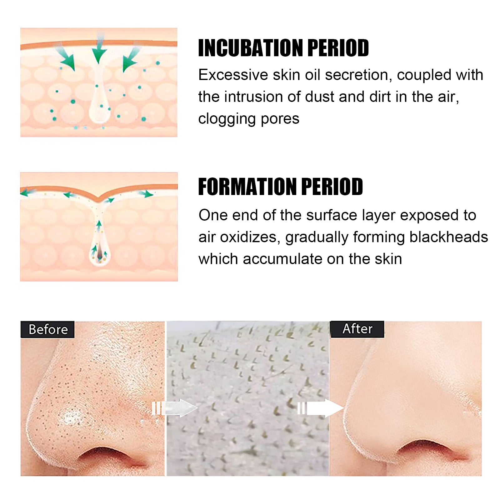 Blackhead Remover Nose Mask, Deeply Cleans And Closes Pore Blackheads And Acne Barbs And Nose Remover Mask Health Eprolo https://www.cyberehub.com