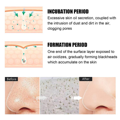Blackhead Remover Nose Mask, Deeply Cleans And Closes Pore Blackheads And Acne Barbs And Nose Remover Mask Health Eprolo https://www.cyberehub.com