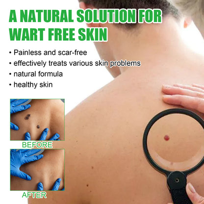 Mole Remover Soap, Repair Meat Granules Corns And Dark Moles, Smooth Skin Anti-wart Cleansing Soap Health Eprolo https://www.cyberehub.com