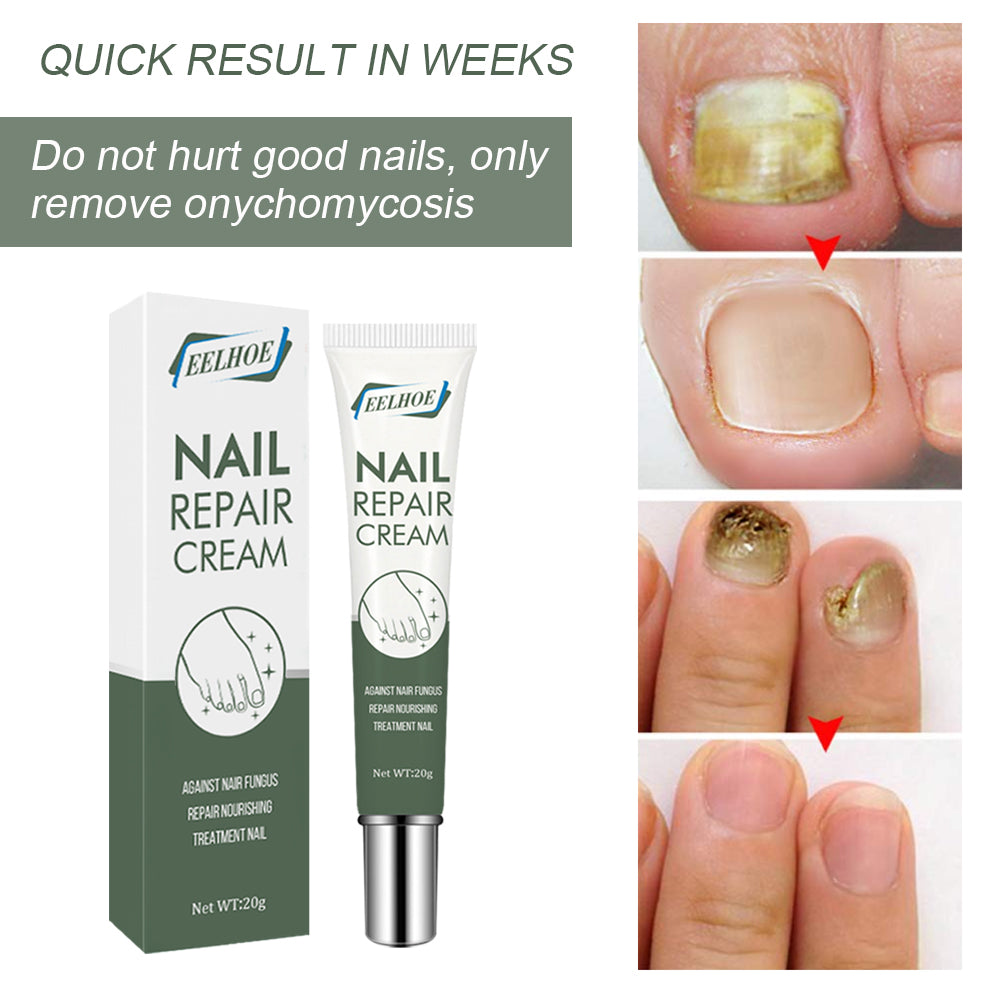 Foot Care And Thickening Nail Repair Cream. Nail Repair Cream Health Eprolo https://www.cyberehub.com