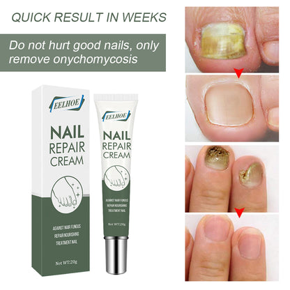 Foot Care And Thickening Nail Repair Cream. Nail Repair Cream Health Eprolo https://www.cyberehub.com