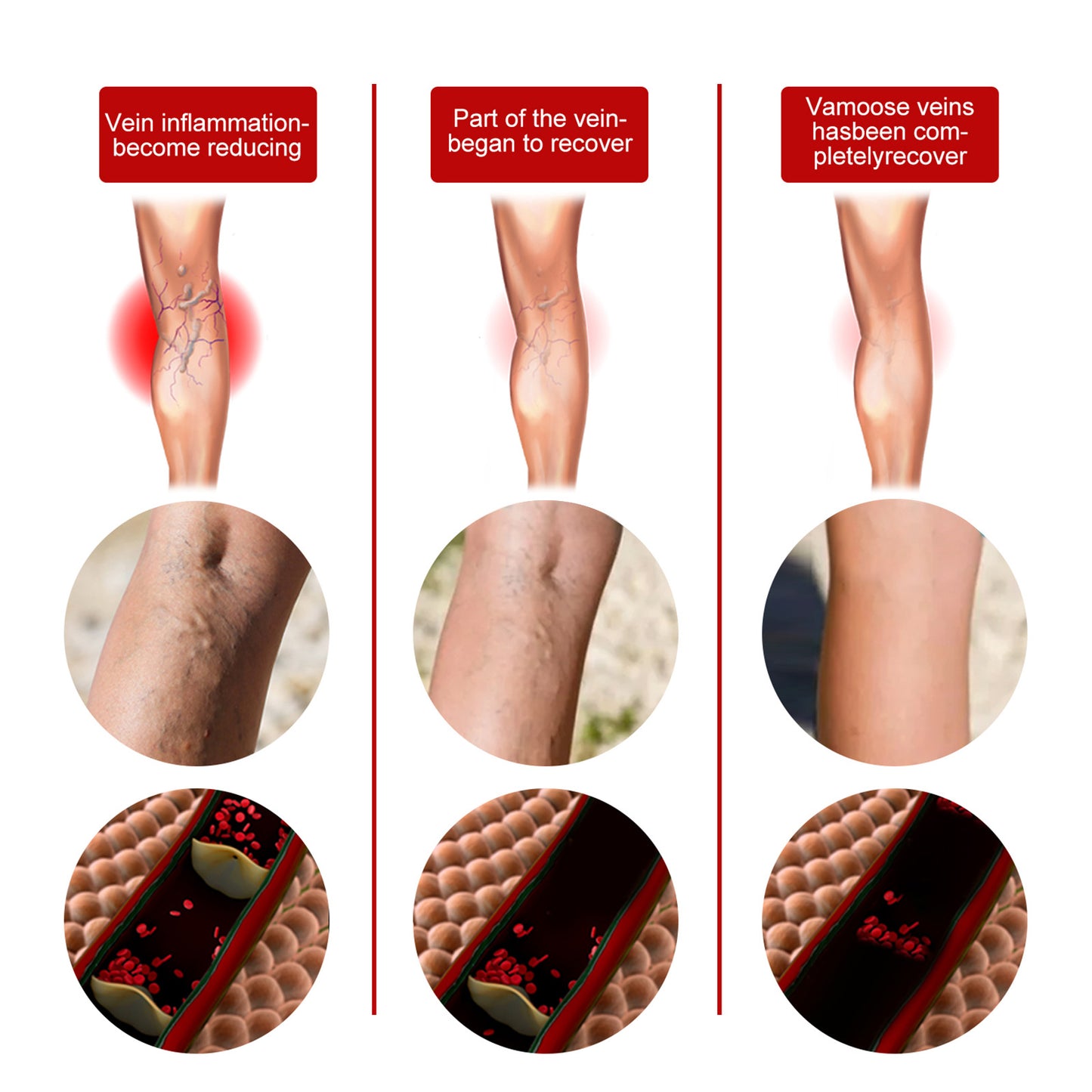Intravenous Massage Spray For Varicose Veins Relief And Earthworm Leg Blood Vessel Bulge Pain Spray Health Eprolo https://www.cyberehub.com