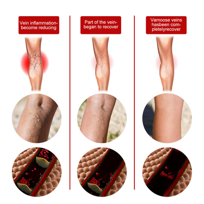 Intravenous Massage Spray For Varicose Veins Relief And Earthworm Leg Blood Vessel Bulge Pain Spray Health Eprolo https://www.cyberehub.com