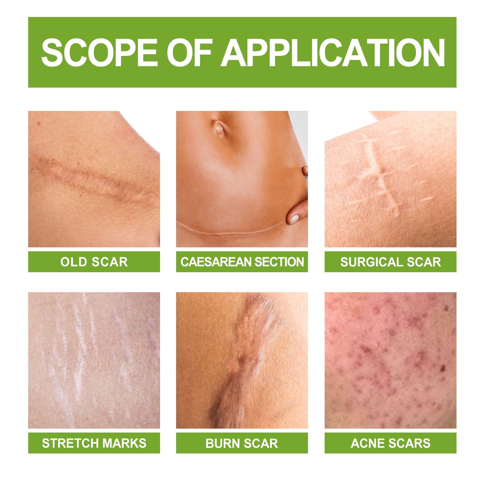 Scar Repair Serum Reduces Scar Acne Mark Pregnancy Surgery Scar Repair Smooth Skin Care Health Eprolo https://www.cyberehub.com