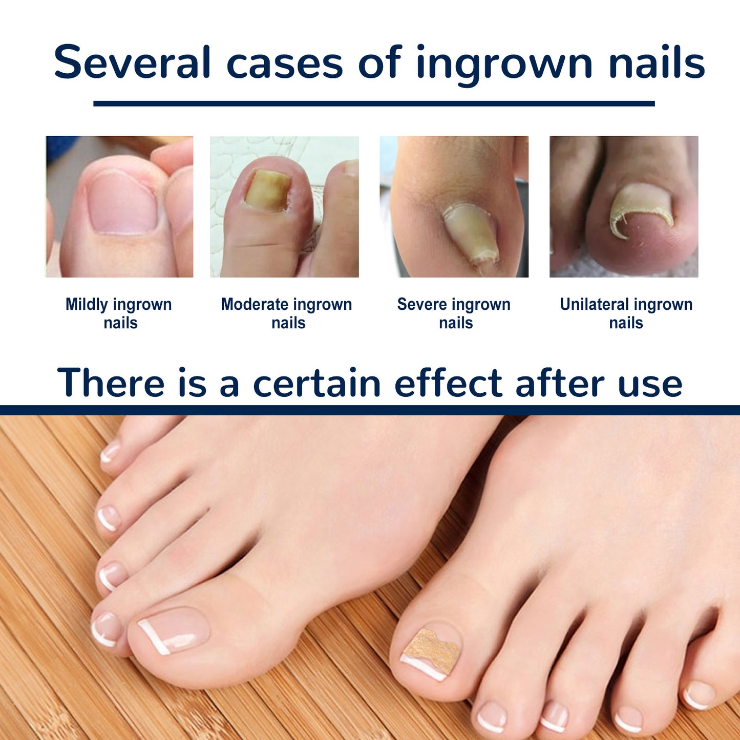 Nail Correction Patch, Nail Insert Correction And Repair Toe Manicure Nail Patch Health Eprolo https://www.cyberehub.com