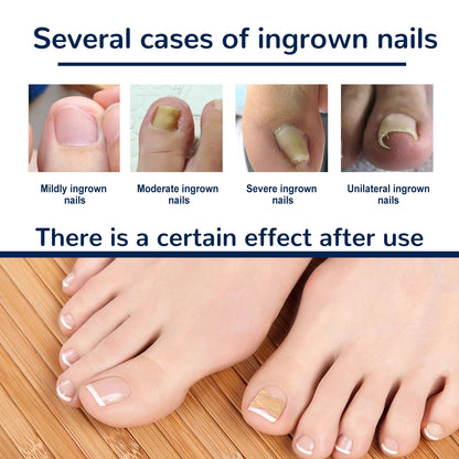 Nail Correction Patch, Nail Insert Correction And Repair Toe Manicure Nail Patch Health Eprolo https://www.cyberehub.com