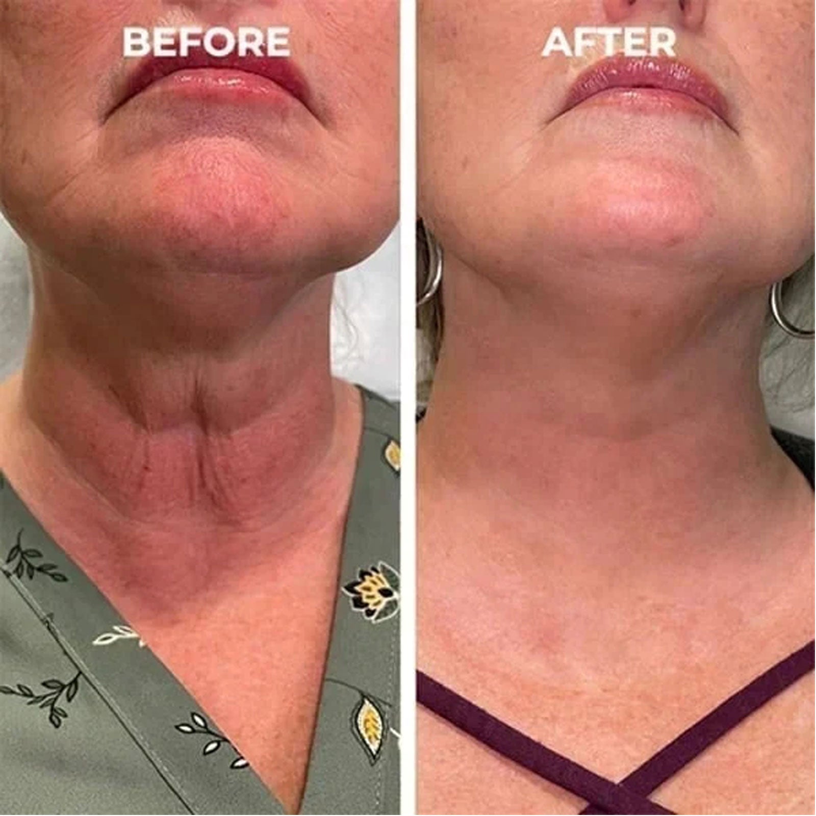 EELHOE Facial Essence, Lifts And Tightens Facial Skin And Reduces Fine Lines And Wrinkles Health Eprolo https://www.cyberehub.com