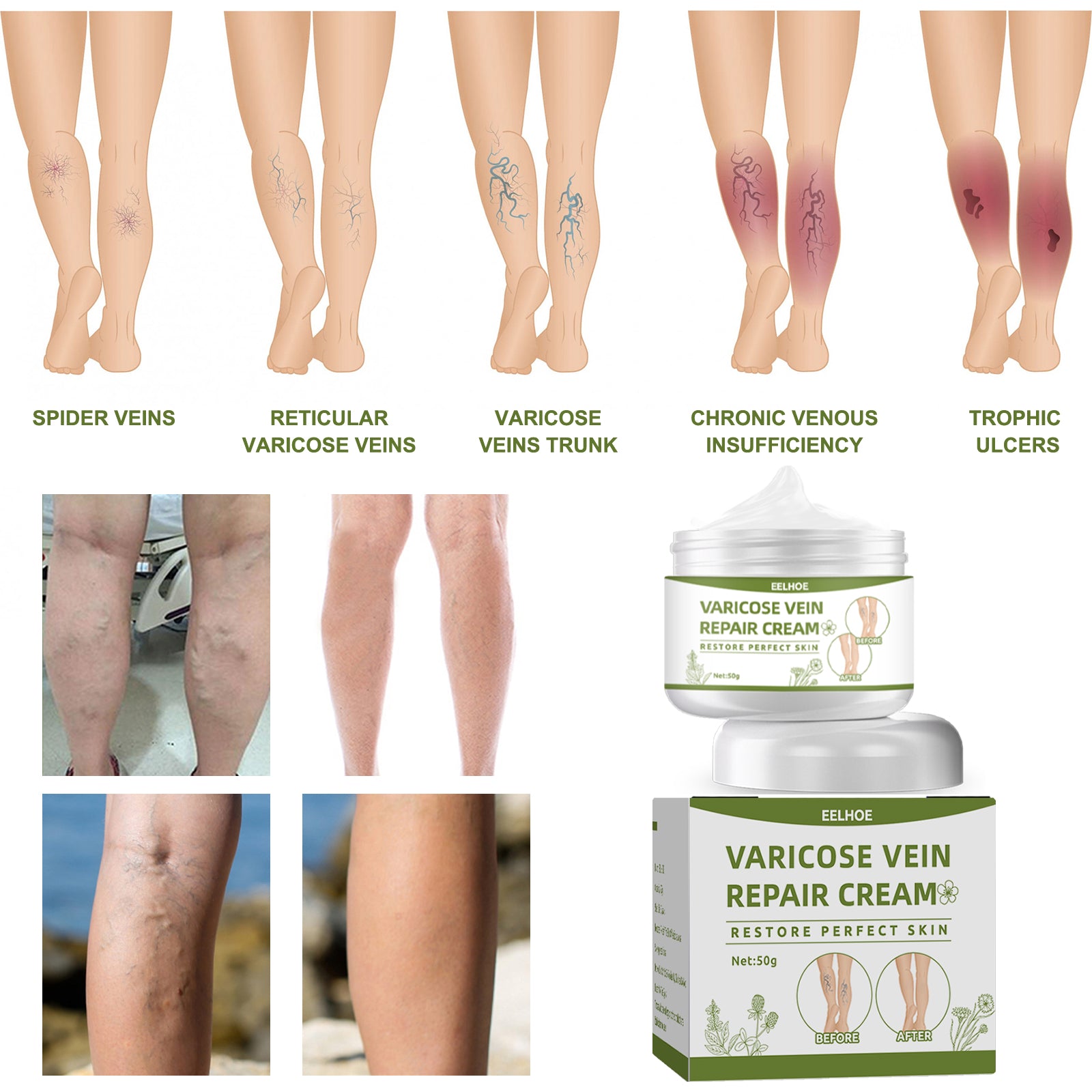 EELHOE Leg Repair Cream Relieves Leg Discomfort Massage Leg Repair Cream For Raised Veins Health & Beauty Health Eprolo https://www.cyberehub.com