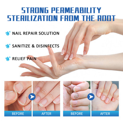 Nail Fungus Treatment Method, Repair Grey Nail Brightening Nail Thickening Nail Hand And Foot Nails Moisturizing Care Cream Health Eprolo https://www.cyberehub.com