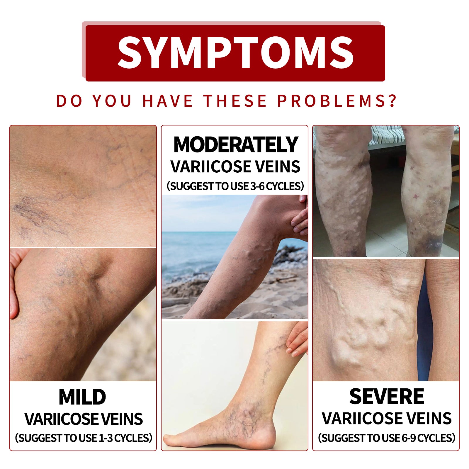 Venous Massage Varicose Cream, Relieves Bulging Leg Blood Vessels And Swollen Leg Earthworm Venous Massage Cream Health Eprolo https://www.cyberehub.com