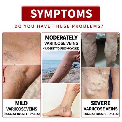 Venous Massage Varicose Cream, Relieves Bulging Leg Blood Vessels And Swollen Leg Earthworm Venous Massage Cream Health Eprolo https://www.cyberehub.com