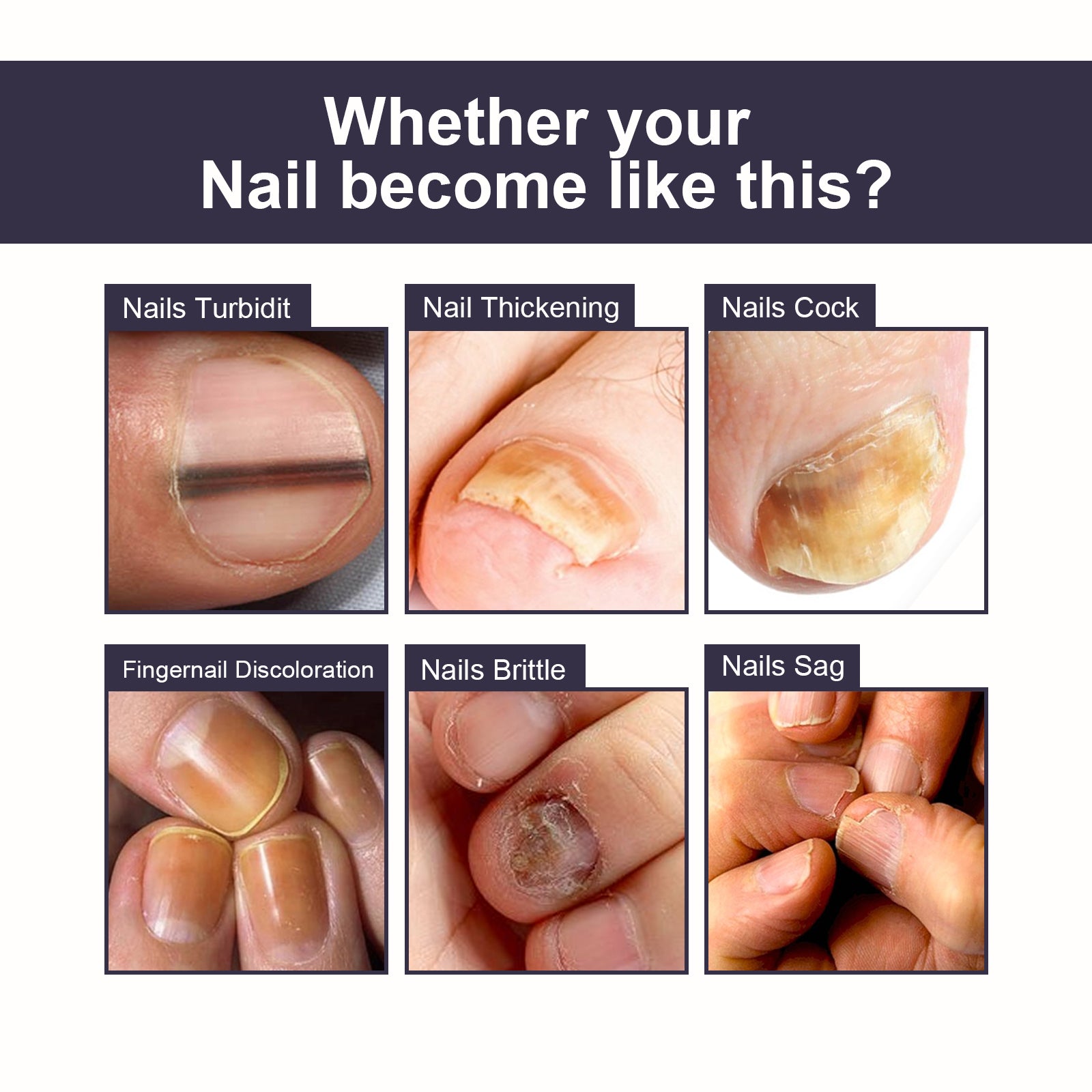 Nail Repair Essence, Soft Nail Thickening Nails Smooth Ingrown Toenails Grey Nails Repair Essence Health Eprolo https://www.cyberehub.com