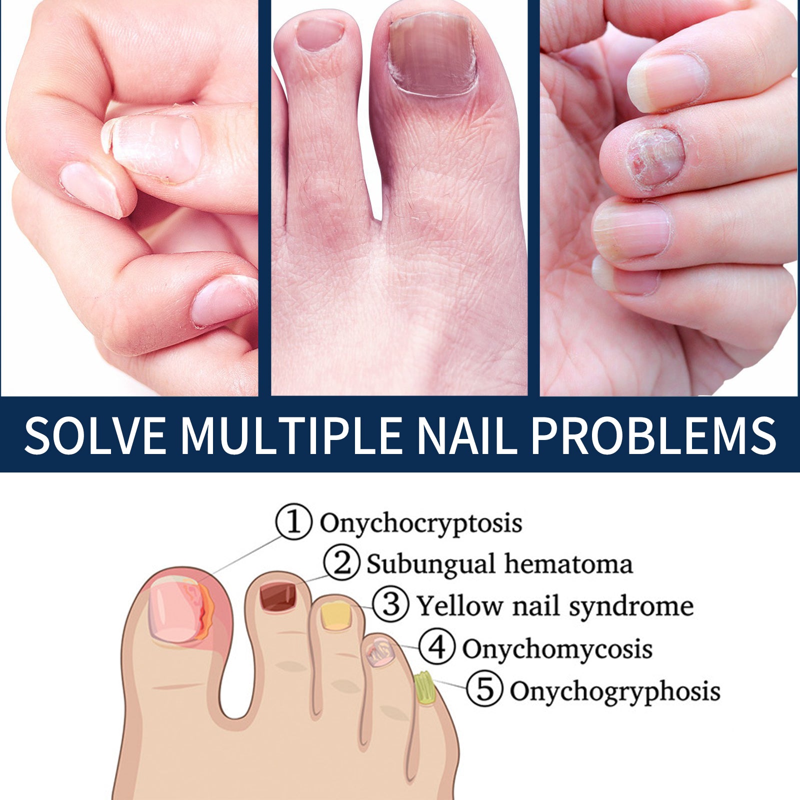 Nail Repair Relieve Essence Pen, Moisturizing Repair Hand And Foot Inlay Nail Thickening Grey Nail Correction Pen Health Eprolo https://www.cyberehub.com