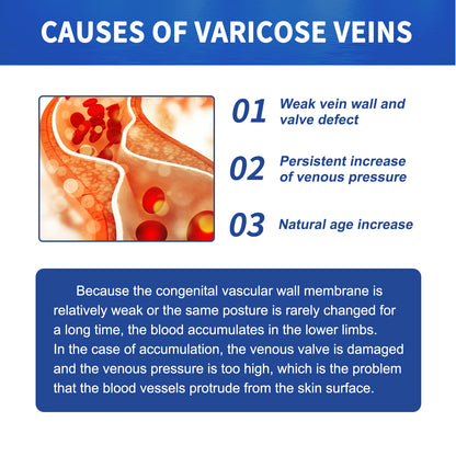 Vein Massage Varicose Cream Repair Earthworm Legs To Relieve Leg Blood Vessel Bulge And Varicoidea Health Eprolo https://www.cyberehub.com