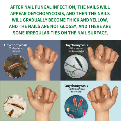 Jaysuing Ginger Nail Care Solution, Repair Hand, Foot And Nail Care Soft Nail Shine Moisturizer Gray Nails Health Eprolo https://www.cyberehub.com