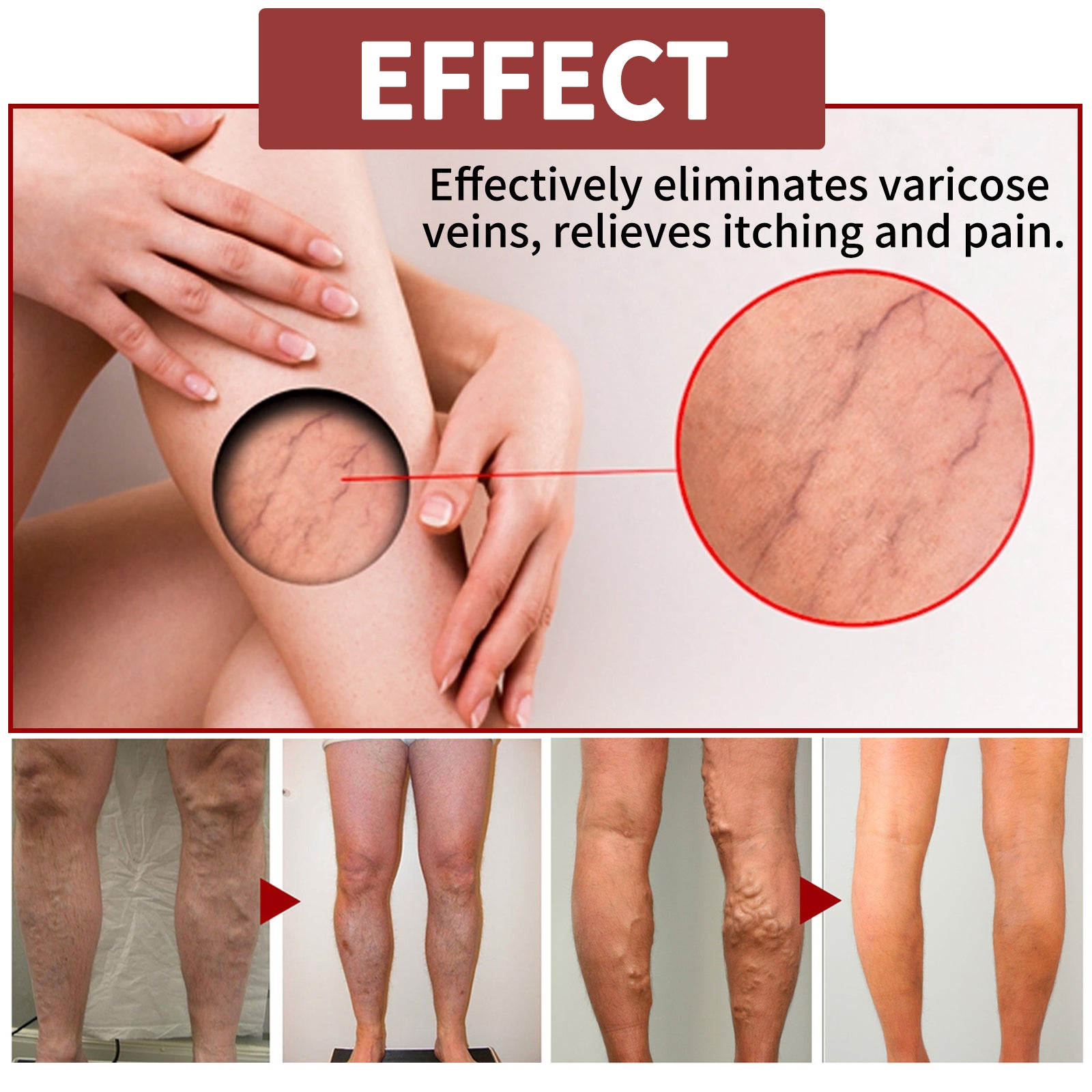 Venous Massage Varicose Cream, Relieves Bulging Leg Blood Vessels And Swollen Leg Earthworm Venous Massage Cream Health Eprolo https://www.cyberehub.com