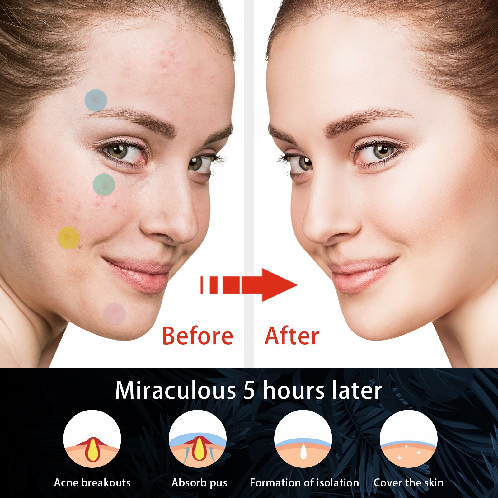Hydrocolloid Acne Patch, Mild Non-Irritant Lightening Acne Pimples Closed Mouth Improve Acne Muscle Hydrocolloidal Acne Patch Health Eprolo https://www.cyberehub.com